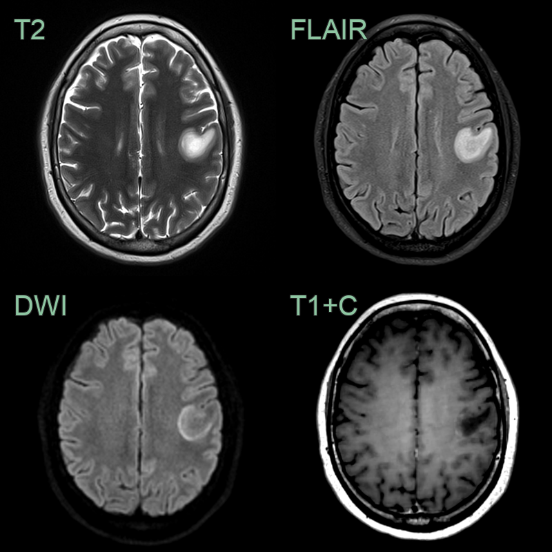 balos_concentric_sclerosis_1