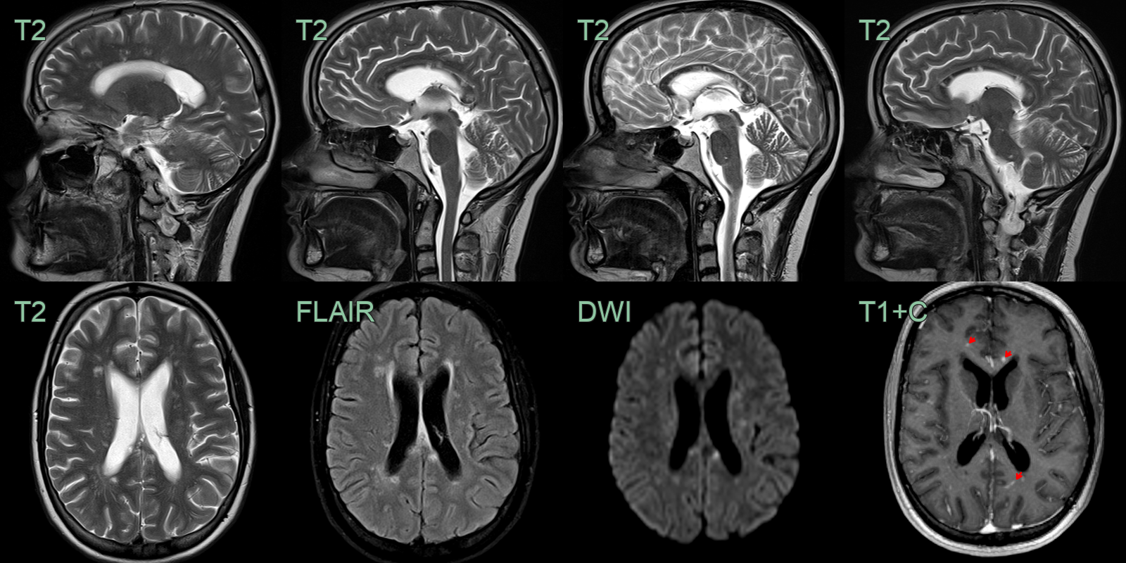 susac_syndrome_1
