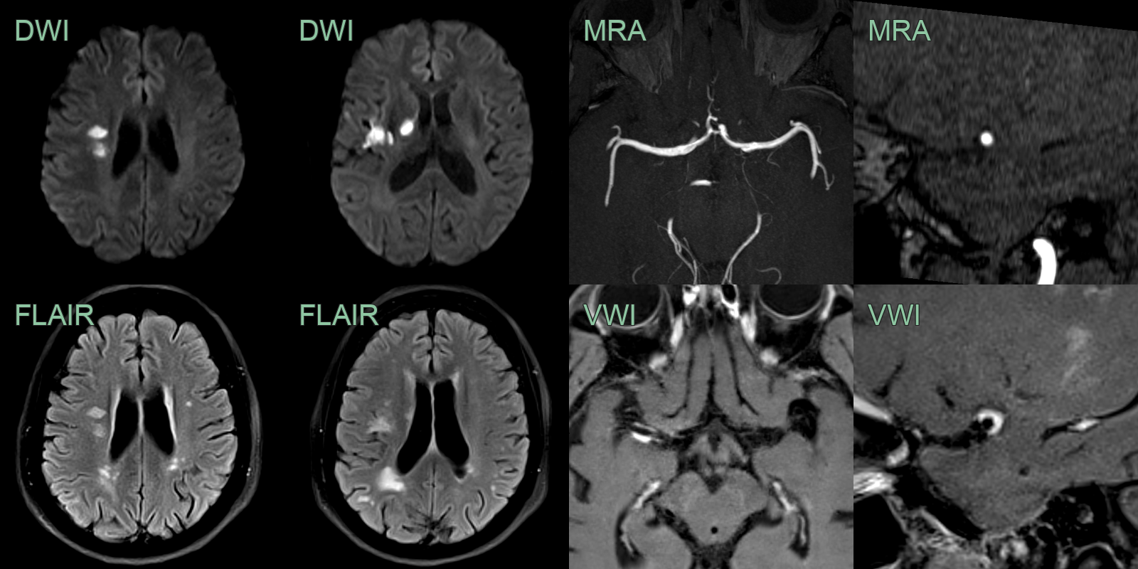 vzv_vasculitis_1